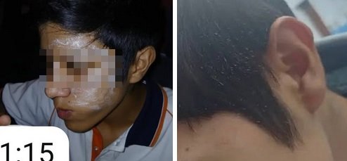 Un estudiante sufrió quemaduras tras un “juego” con fuego en una escuela de Banda del Río Salí